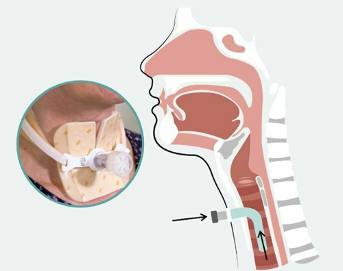 Billede af trakseostomi