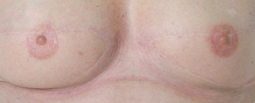 Rekonstruerede brystvorter med tatovering